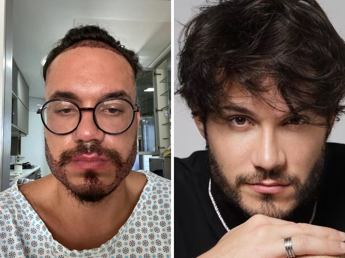 famosos transplante capilar